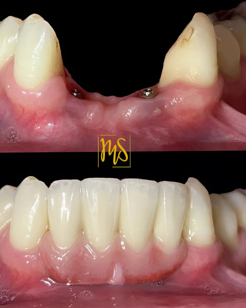 Implantes